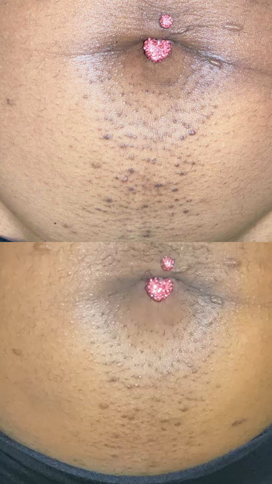 How to get rid of ingrown hairs on your bikini line
