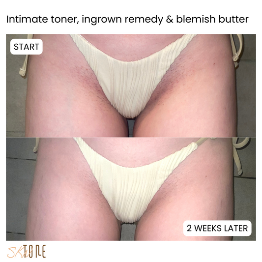 Hyperpigmentation on the bikini line - How to get rid of discolouration in the bikini area