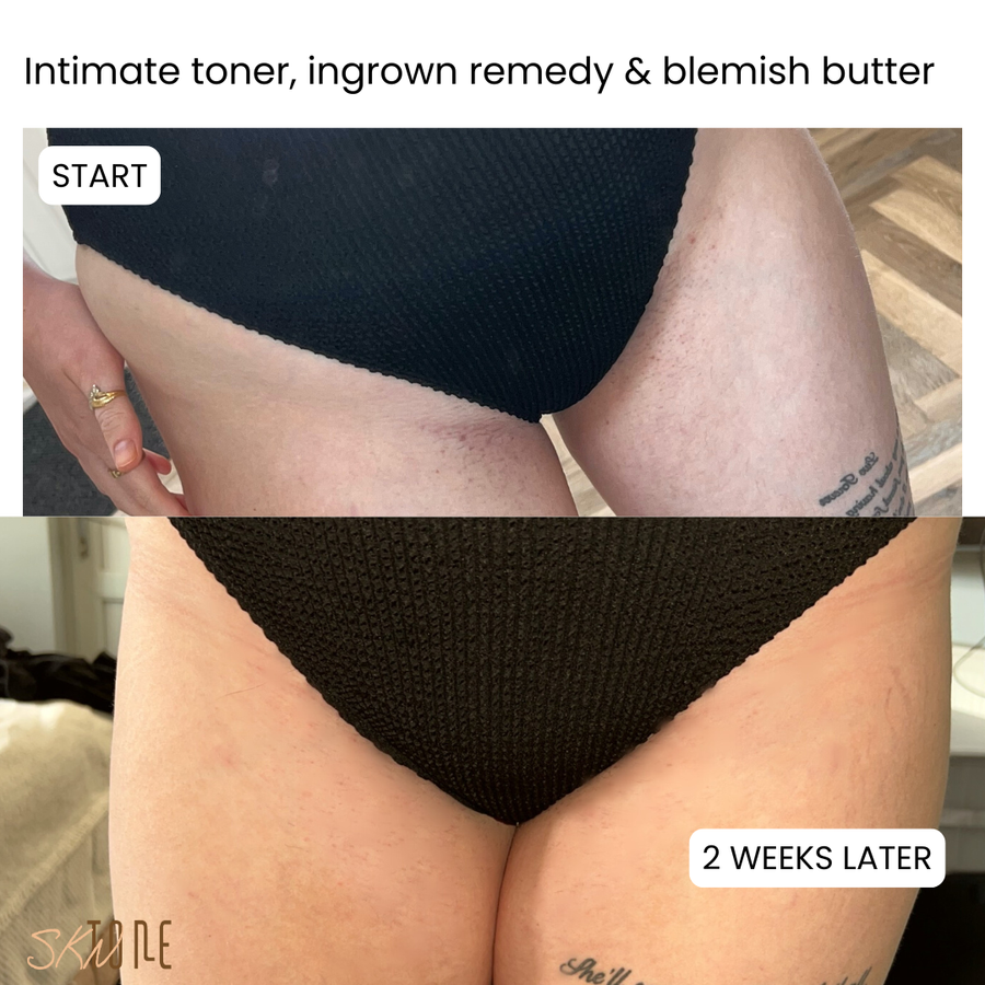 Customer before and after using Intimate Toner, Ingrown Remedy + Blemish Butter