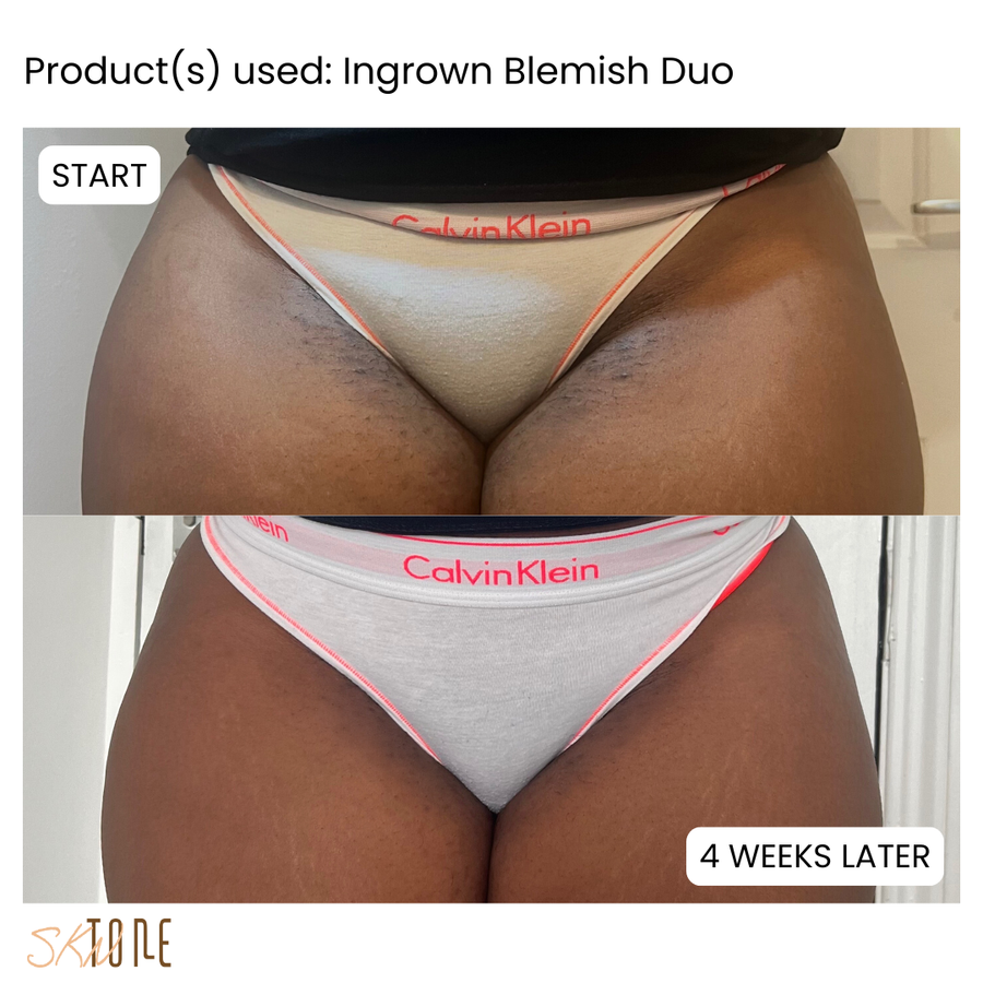 Customer before and after using Ingrown Remedy + Blemish Butter
