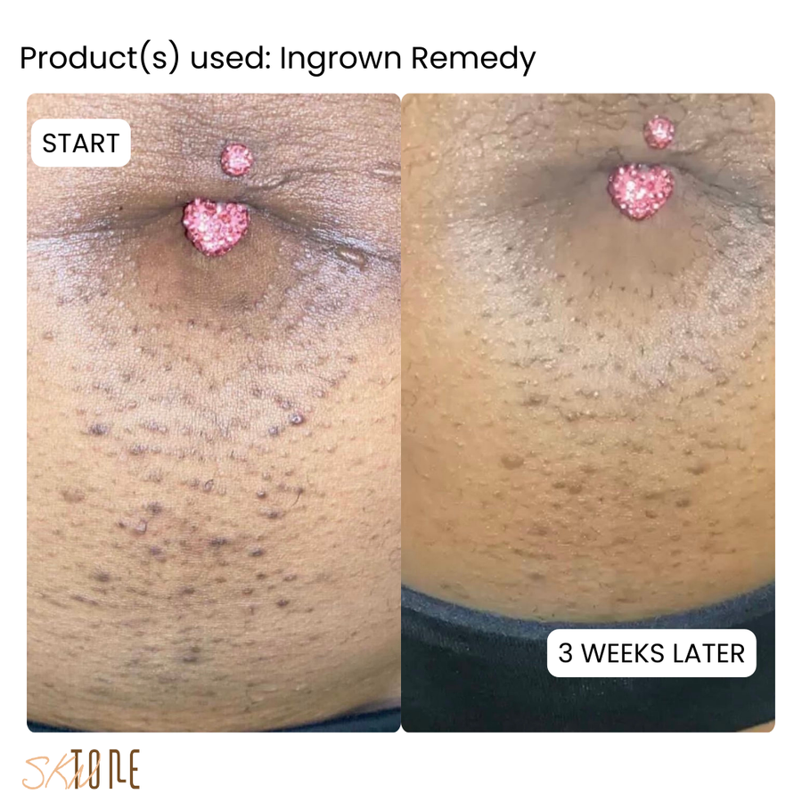 Customer before and after using Ingrown Remedy