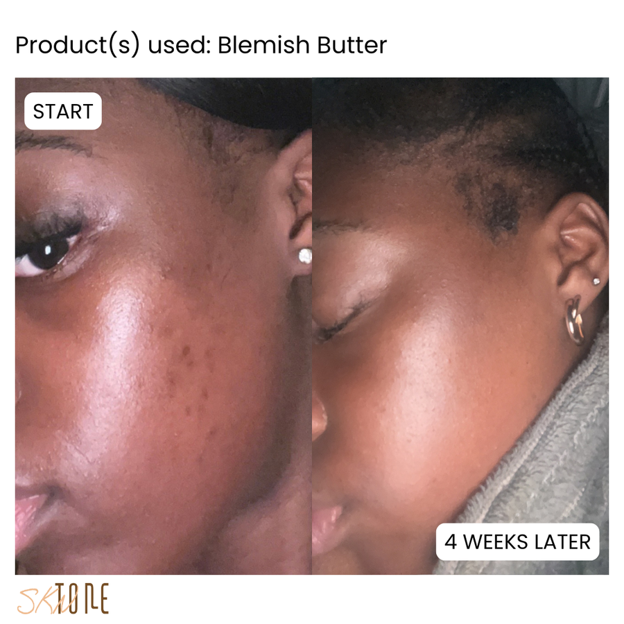 Customer before and after using Blemish Butter