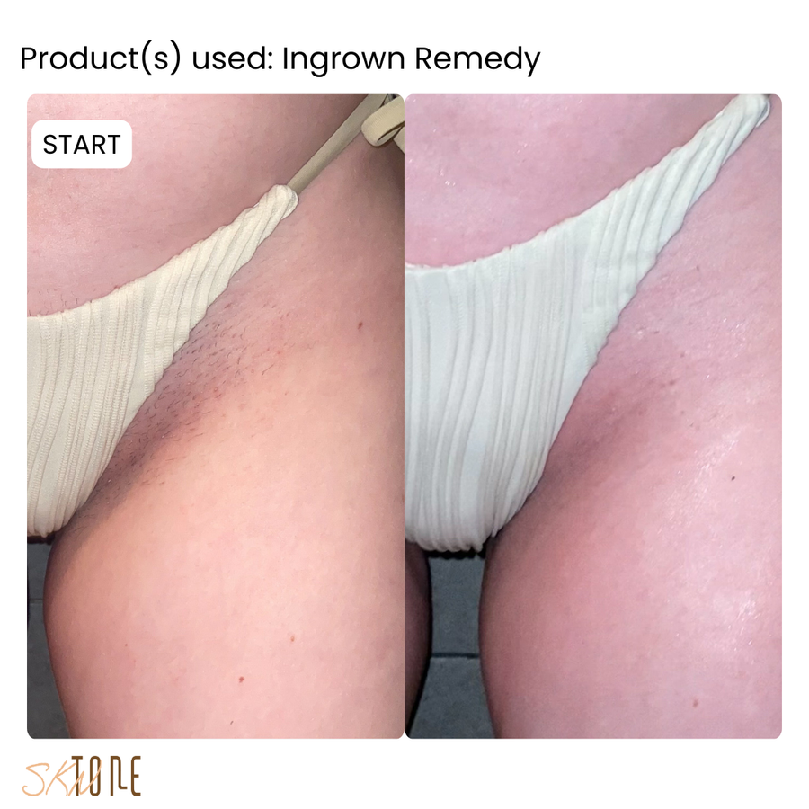 Customer before and after using Ingrown Remedy